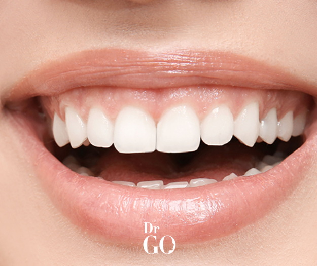 Gummy Smile