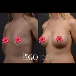 breast augmentation in Turkey