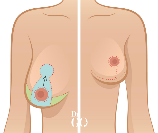 Breast Reduction Surgery