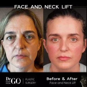 Best Face Lift Surgeon Istanbul, Turkey | Assoc. Prof. Dr. Guncel Ozturk 2 Best Face Lift Surgeon Istanbul, Turkey