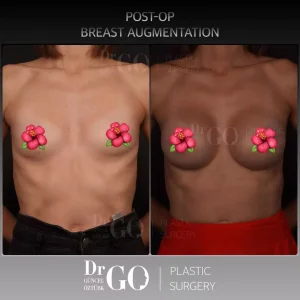 Best Breast Augmentation Surgeon Istanbul