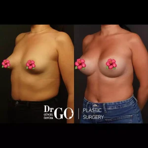 Best Breast Augmentation Surgeon Istanbul