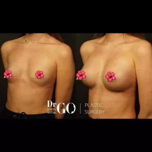 Best Breast Augmentation Surgeon Istanbul