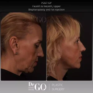 Best Face Lift Surgeon Istanbul, Turkey | Assoc. Prof. Dr. Guncel Ozturk 6 Best Face Lift Surgeon Istanbul, Turkey
