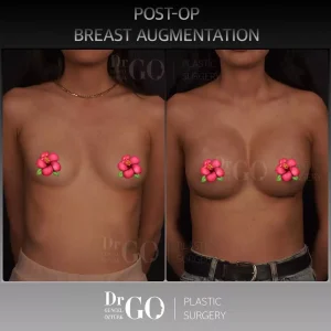 Best Breast Augmentation Surgeon Istanbul