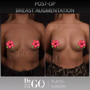 Best Breast Augmentation Surgeon Istanbul