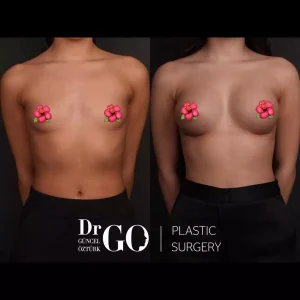 Best Breast Augmentation Surgeon Istanbul