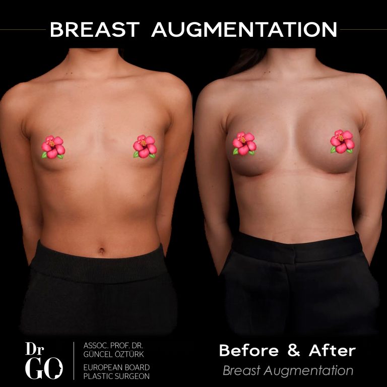 Rhino - BA - 1 - breast.jpg