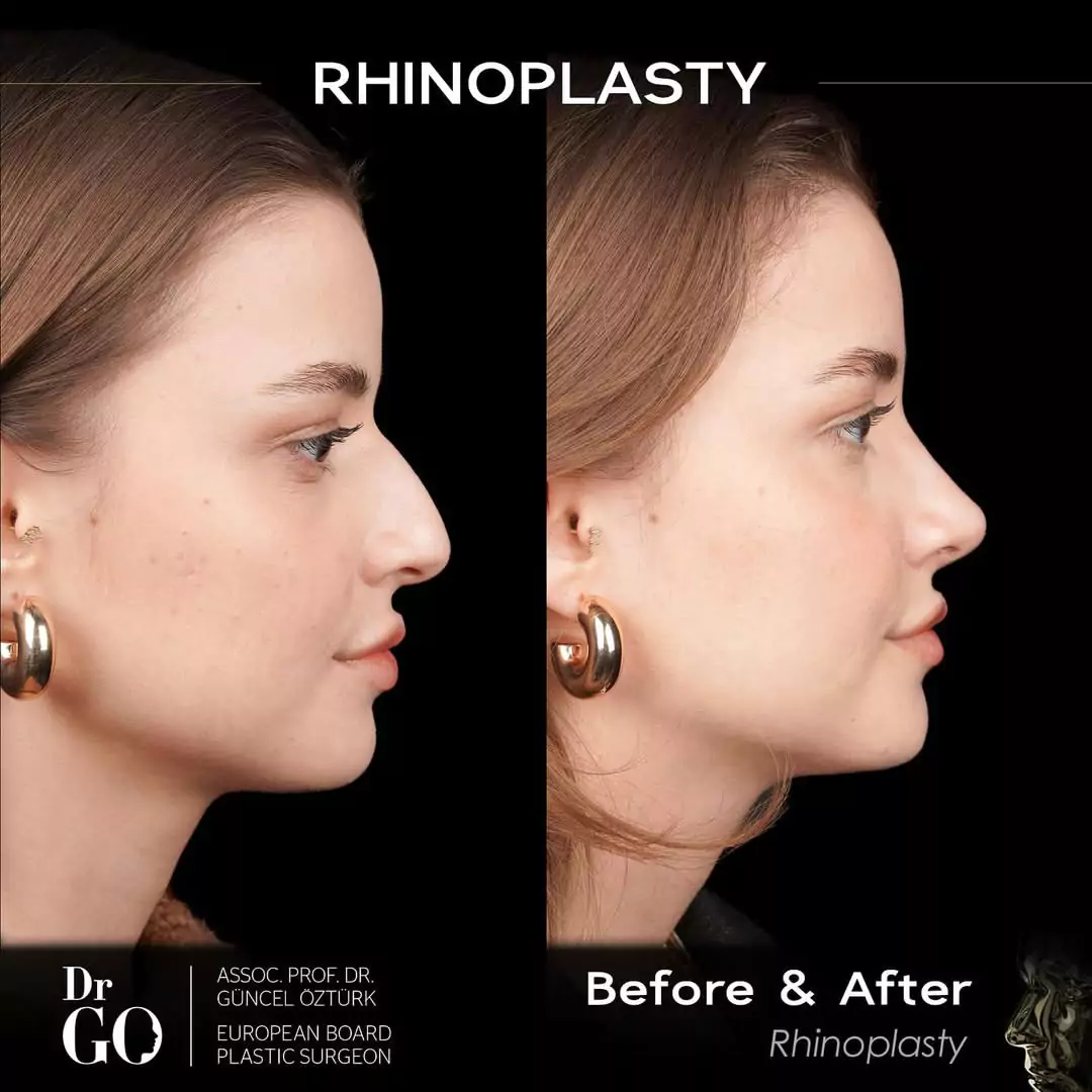 Let Down Rhinoplasty 8 beforeafter-1
