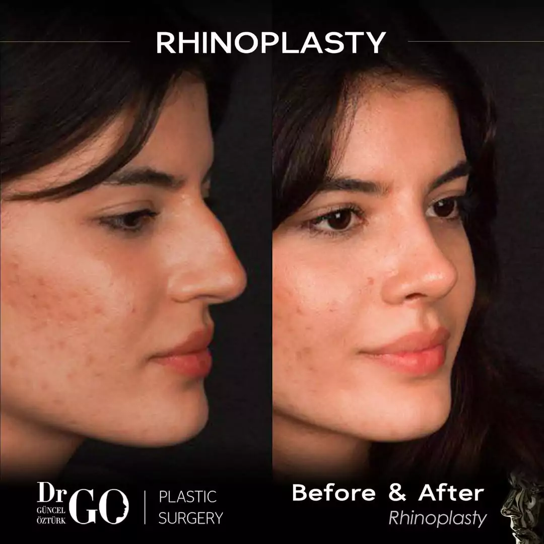 Let Down Rhinoplasty 10 beforeafter-11