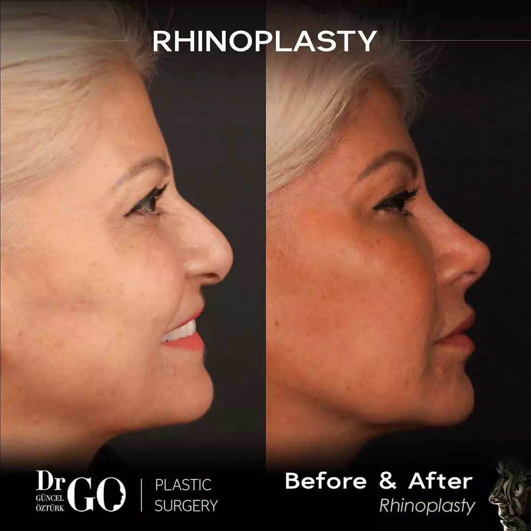 Let Down Rhinoplasty 11 beforeafter-12