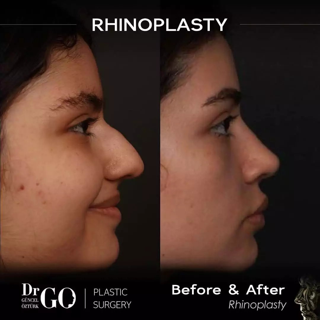 Let Down Rhinoplasty 9 beforeafter-13
