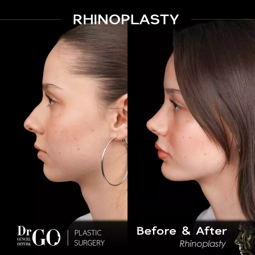 Let Down Rhinoplasty 3 beforeafter-2