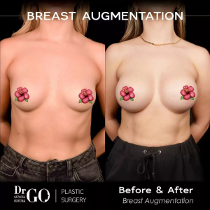 Best Breast Augmentation Surgeon Istanbul