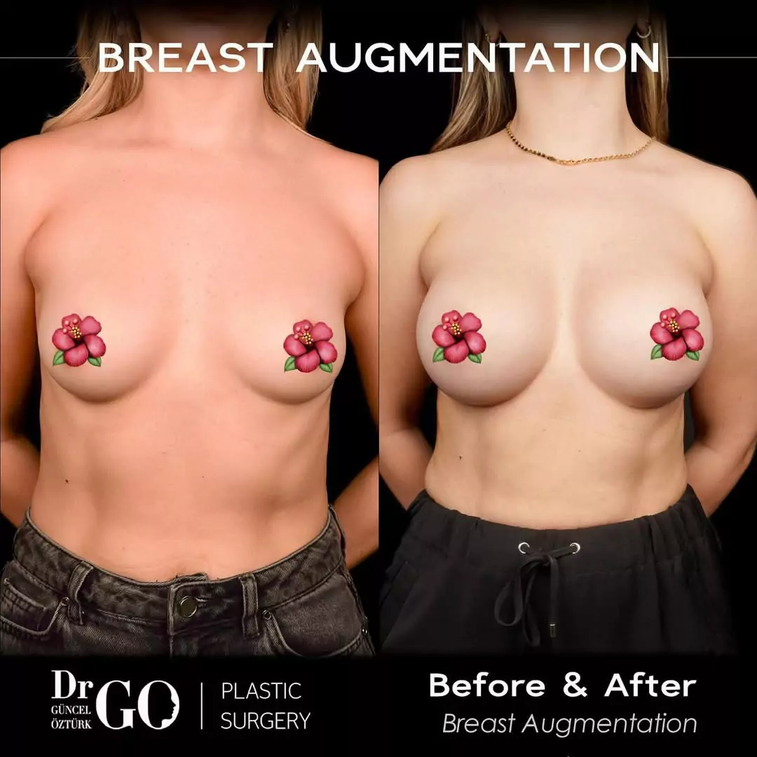Breast Augmentation Aesthetics 5 beforeafter-3