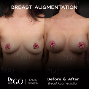 Best Breast Augmentation Surgeon Istanbul