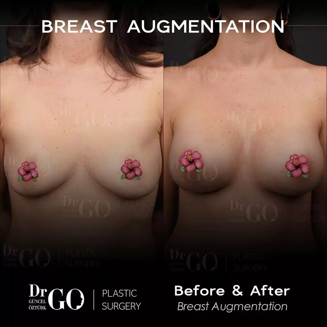 Breast Augmentation Aesthetics 4 beforeafter-4