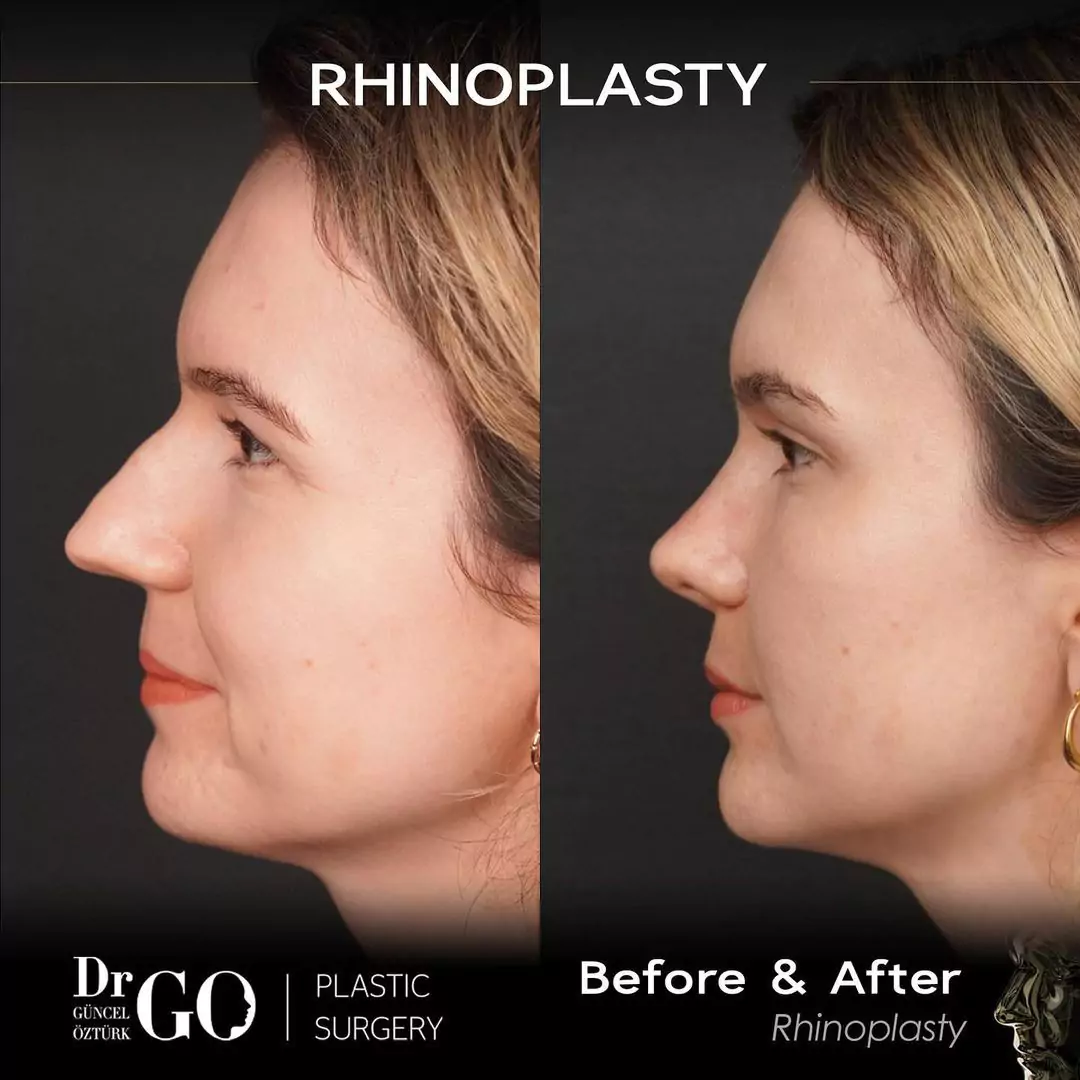 Let Down Rhinoplasty 2 beforeafter-8