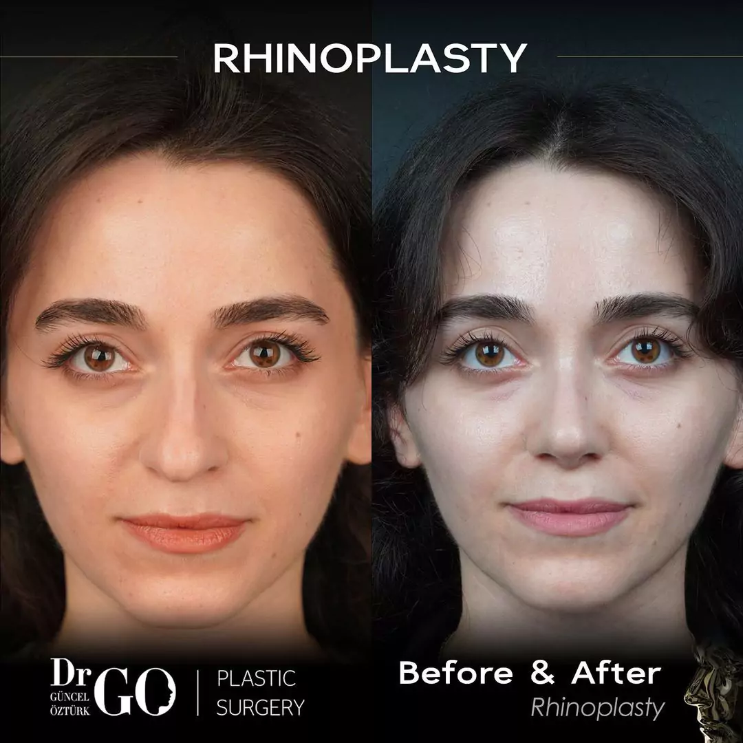 Let Down Rhinoplasty 4 beforeafter-9