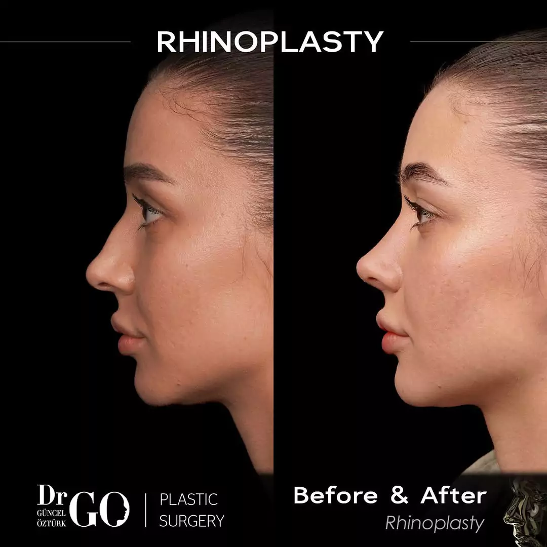 Let Down Rhinoplasty 1 rhinoplasty in turkey