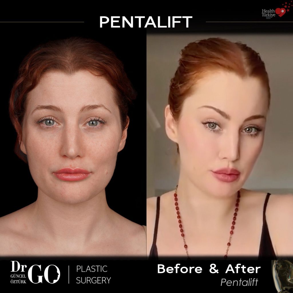 best temporal lift in Istanbul, Turkey