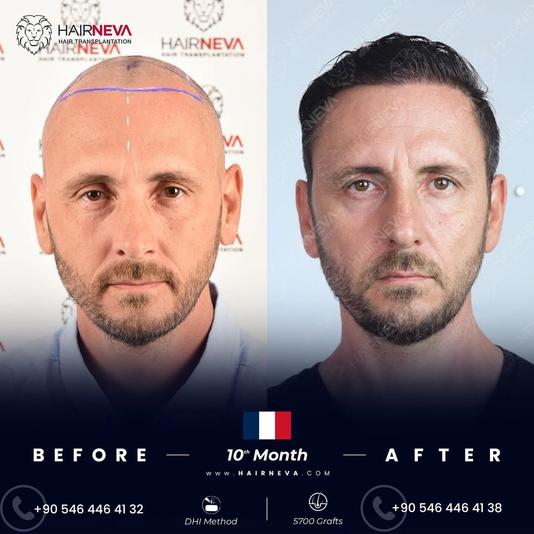 Best Hair Transplant Surgeon Istanbul, Turkey | Assoc. Prof. Dr. Guncel Ozturk, Expert Hair Restoration 6 best hair transplant in turkey