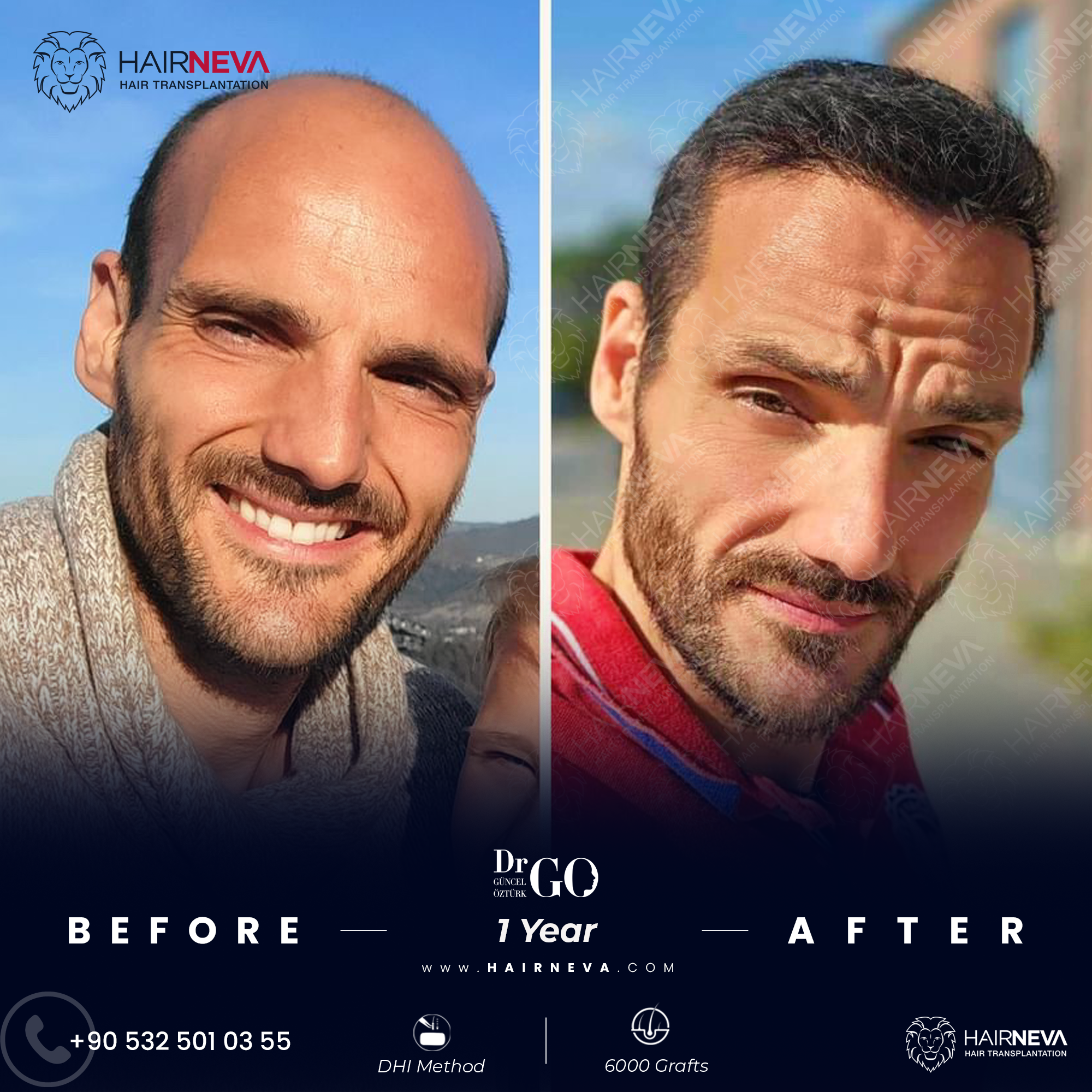 Best Hair Transplant Surgeon Istanbul, Turkey | Assoc. Prof. Dr. Guncel Ozturk, Expert Hair Restoration 5 best hair transplant in turkey