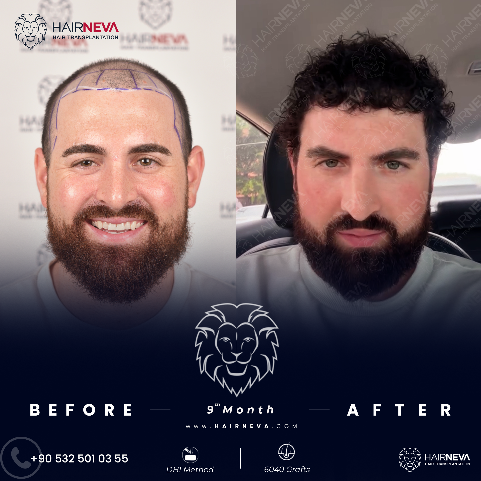Best Hair Transplant Surgeon Istanbul, Turkey | Assoc. Prof. Dr. Guncel Ozturk, Expert Hair Restoration 3 best hair transplant in turkey