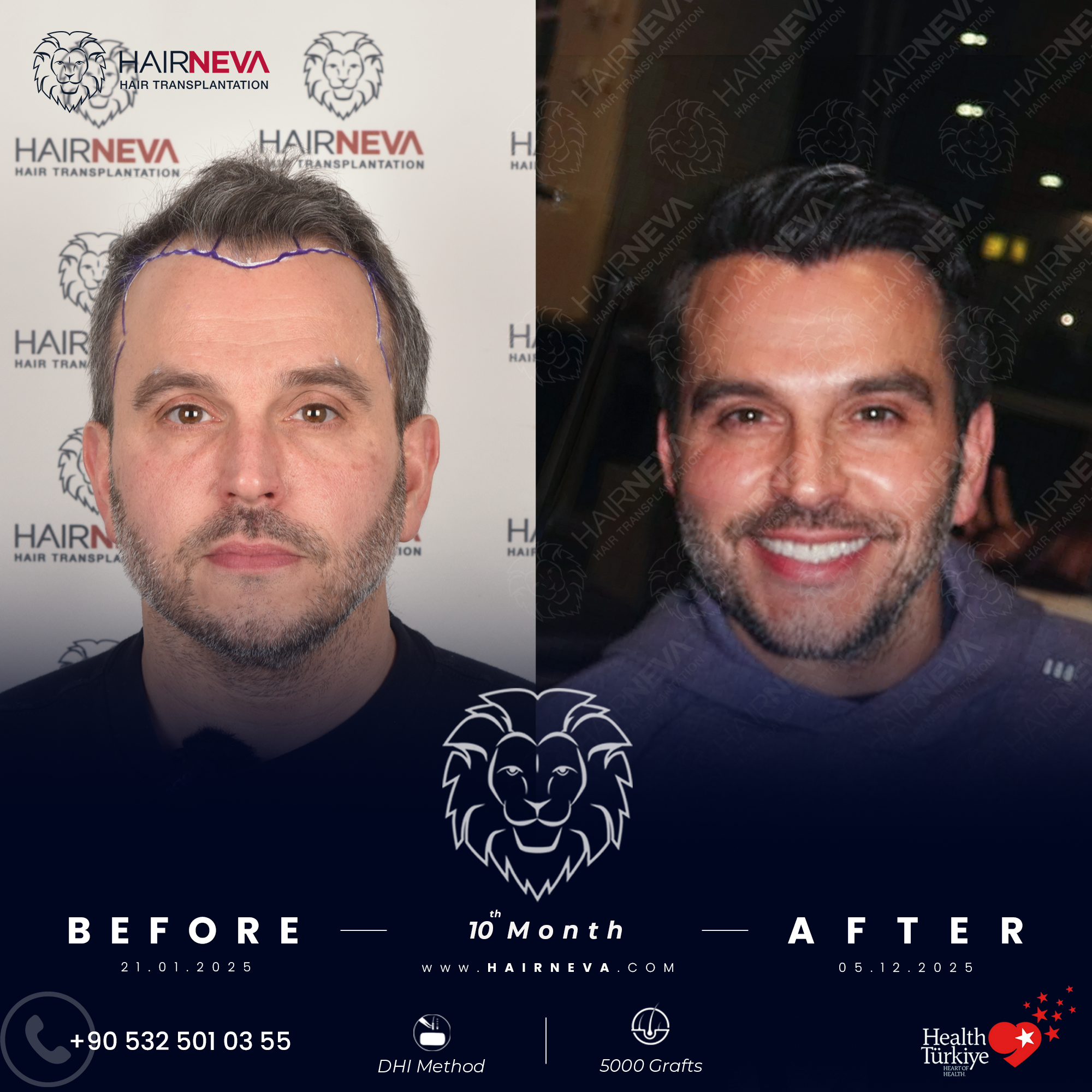 Best Hair Transplant Surgeon Istanbul, Turkey | Assoc. Prof. Dr. Guncel Ozturk, Expert Hair Restoration 2 best hair transplant in turkey