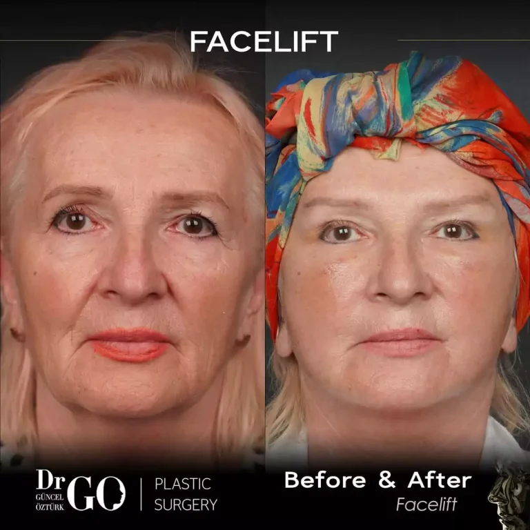 начална страница 122 beforeafter-9-1-2.webp