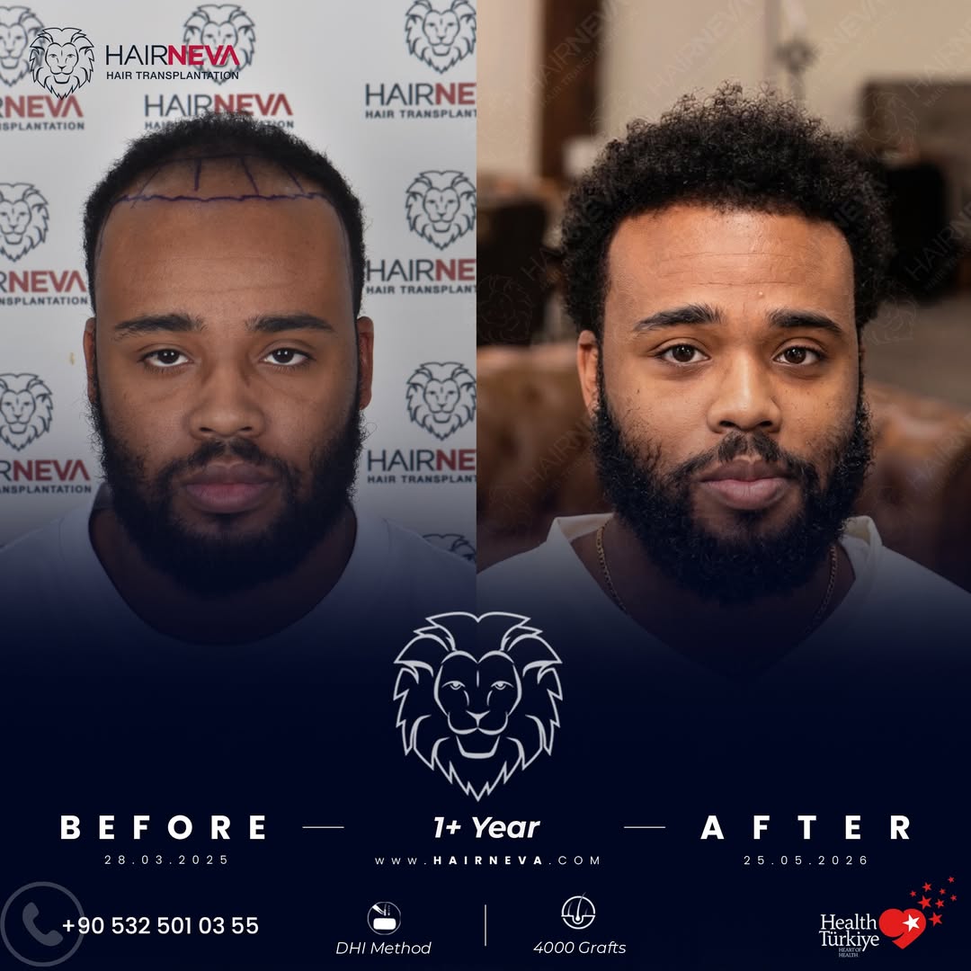 La migliore clinica per trapianti di capelli afro a Istanbul, Turchia | Dr. Güncel Öztürk, specialista in restauro dei capelli 4 BeforeAfter-Hair