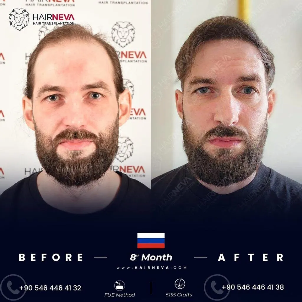 Migliore clinica per trapianto di capelli FUE a Istanbul, Turchia | Prof. Associato Dott. Guncel Ozturk, Esperto in Ripristino dei Capelli 3 Best FUE