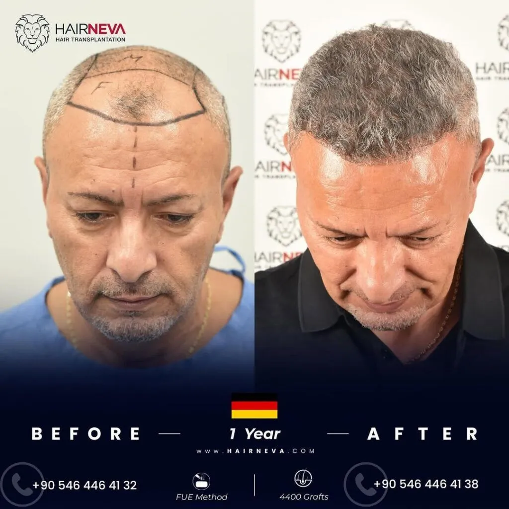 Migliore clinica per trapianto di capelli FUE a Istanbul, Turchia | Prof. Associato Dott. Guncel Ozturk, Esperto in Ripristino dei Capelli 4 Best FUE Hair Transplant Clinic in Turkey