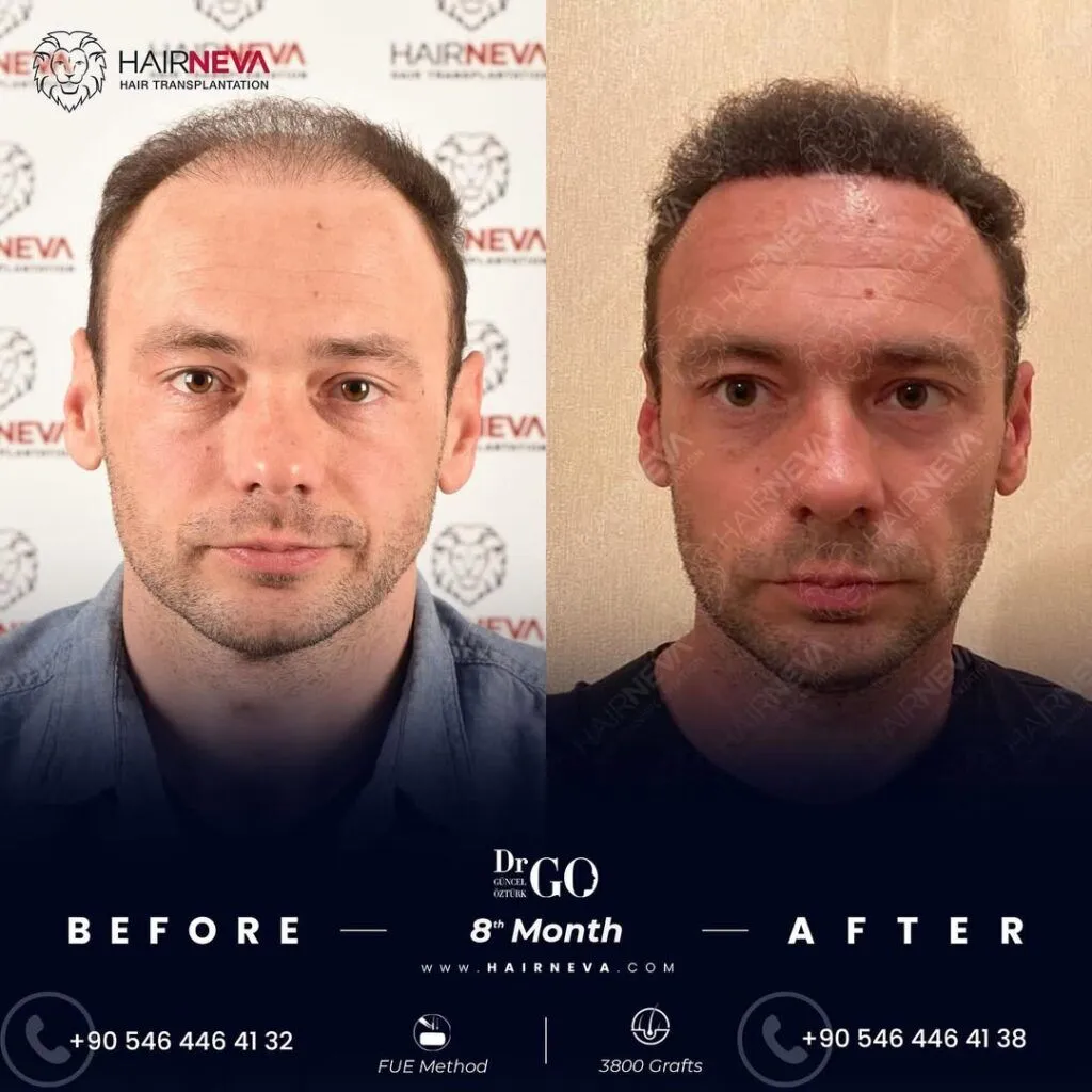 Migliore clinica per trapianto di capelli FUE a Istanbul, Turchia | Prof. Associato Dott. Guncel Ozturk, Esperto in Ripristino dei Capelli 5 Best FUE Hair Transplant Clinic in Turkey
