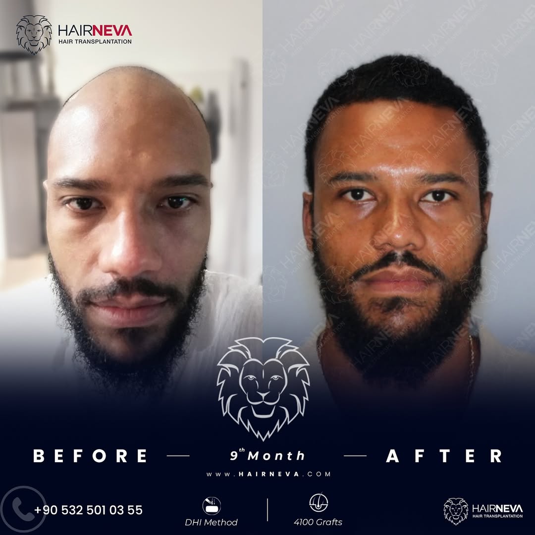 La migliore clinica per trapianti di capelli afro a Istanbul, Turchia | Dr. Güncel Öztürk, specialista in restauro dei capelli 5 Hair-Transplant-in-Turkey