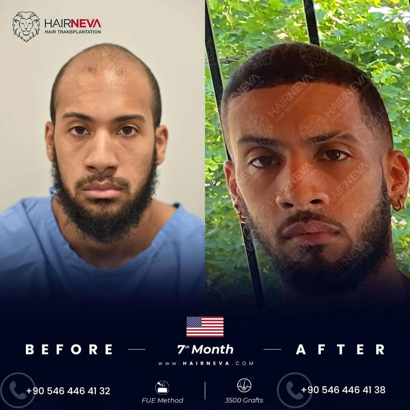 La migliore clinica per trapianti di capelli afro a Istanbul, Turchia | Dr. Güncel Öztürk, specialista in restauro dei capelli 6 Hairneva-Before-After-Final-13_2026-2