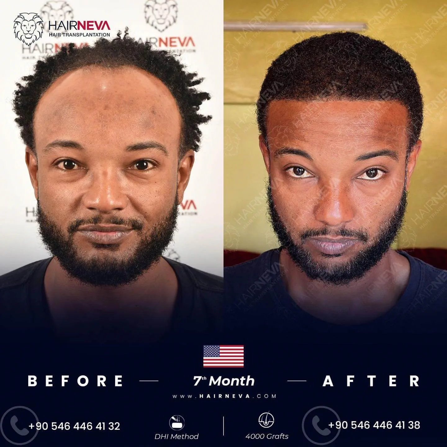 La migliore clinica per trapianti di capelli afro a Istanbul, Turchia | Dr. Güncel Öztürk, specialista in restauro dei capelli 3 Hairneva-Before-After-Final-14_2026-2