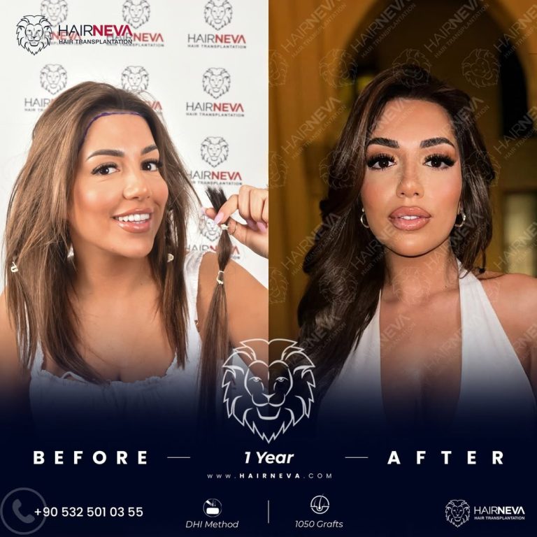 Best Female Hair Transplant Clinic Istanbul, Turkey | Assoc. Prof. Dr. Guncel Ozturk, Expert Hair Restoration 4 SaveClip.App_654698566_18065411414320148_945933589058033085_n