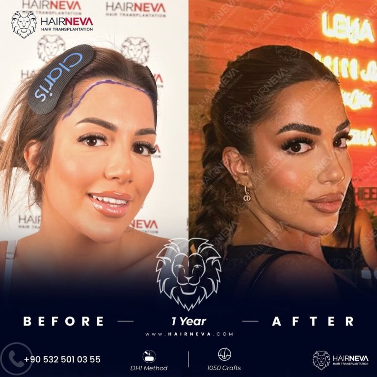 Best Female Hair Transplant Clinic Istanbul, Turkey | Assoc. Prof. Dr. Guncel Ozturk, Expert Hair Restoration 5 SaveClip.App_662843866_18206981605329836_5160663078581469852_n