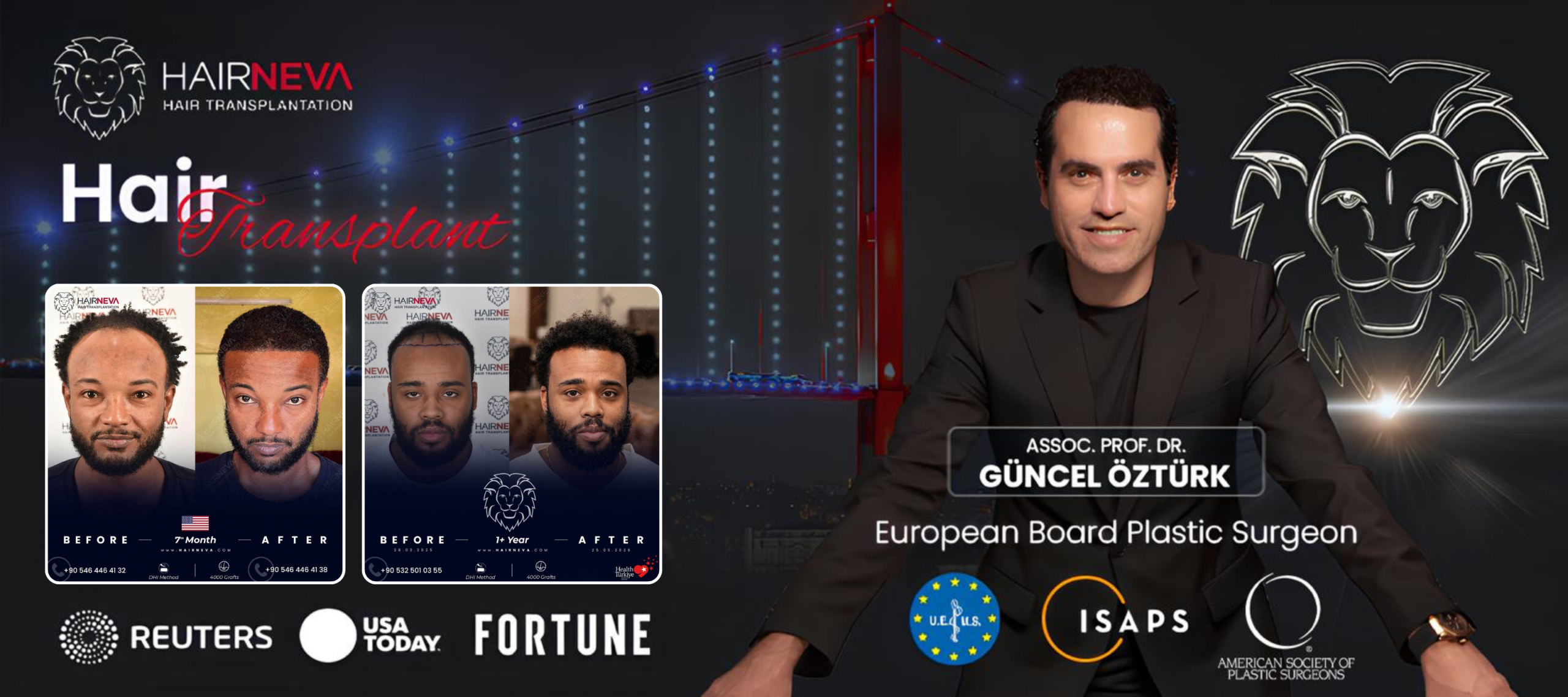 La migliore clinica per trapianti di capelli afro a Istanbul, Turchia | Dr. Güncel Öztürk, specialista in restauro dei capelli 2 La migliore clinica per trapianti di capelli afro a Istanbul, Turchia | Dr. Güncel Öztürk, specialista in restauro dei capelli
