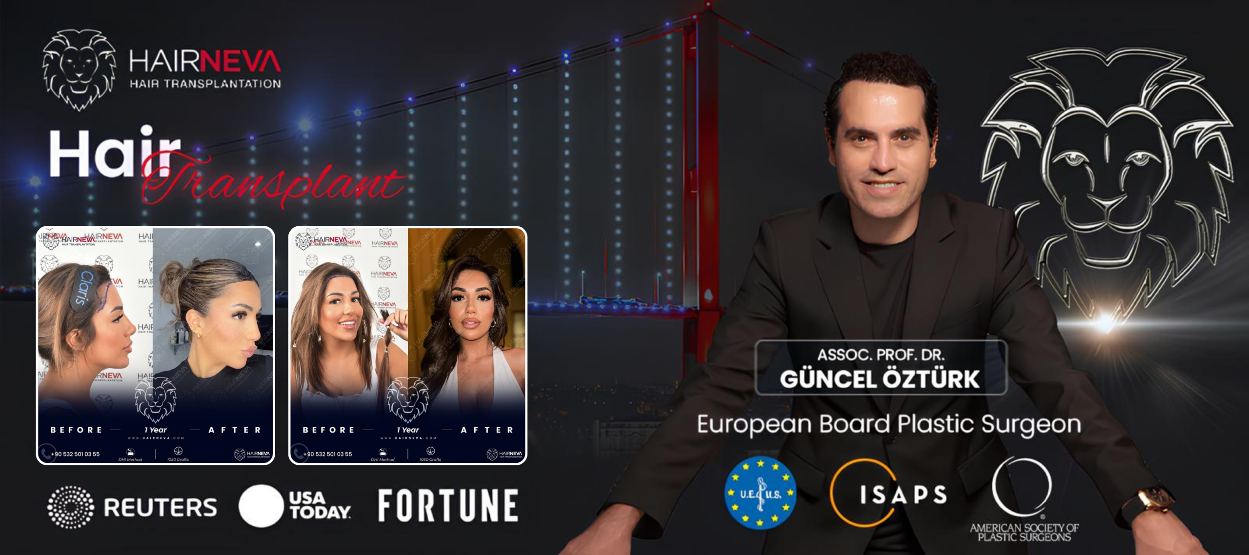 Best Female Hair Transplant Clinic Istanbul, Turkey | Assoc. Prof. Dr. Guncel Ozturk, Expert Hair Restoration 2 female hair transplant clinic in turkey