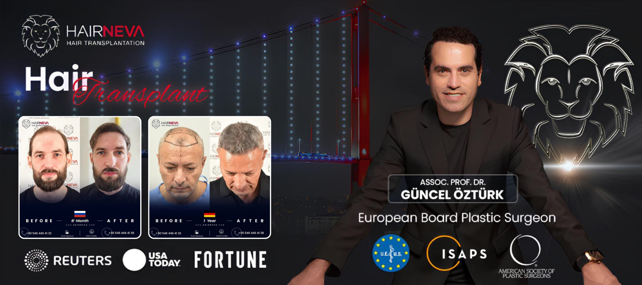 Migliore clinica per trapianto di capelli FUE a Istanbul, Turchia | Prof. Associato Dott. Guncel Ozturk, Esperto in Ripristino dei Capelli 2 best fue hair clinic in turkey