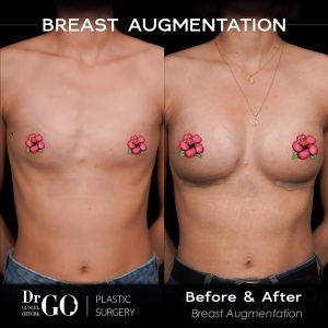 best breast augmentation in turkey