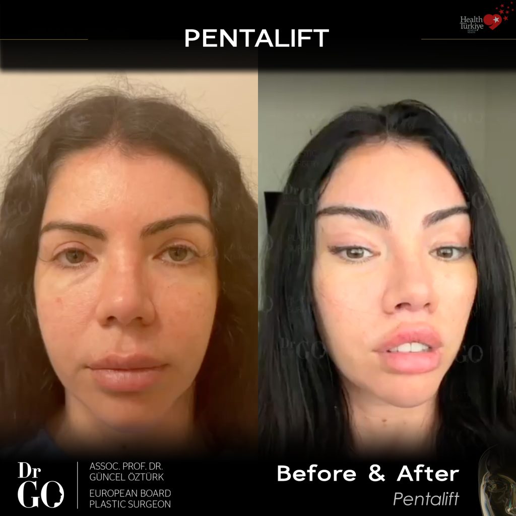Pentalift - BA - 2000X2000.jpg
