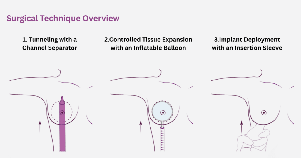 Preserve Breast Augmentation 1 Preserve Breast Augmentation