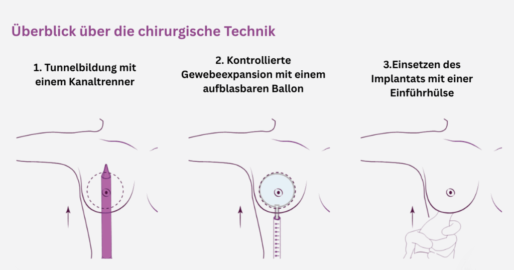 Brustvergrößerung mit Preserve