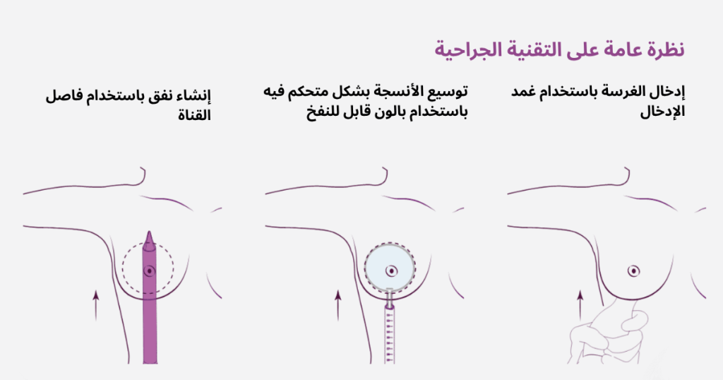 الحفاظ على تكبير الثدي 1 الحفاظ على تكبير الثدي