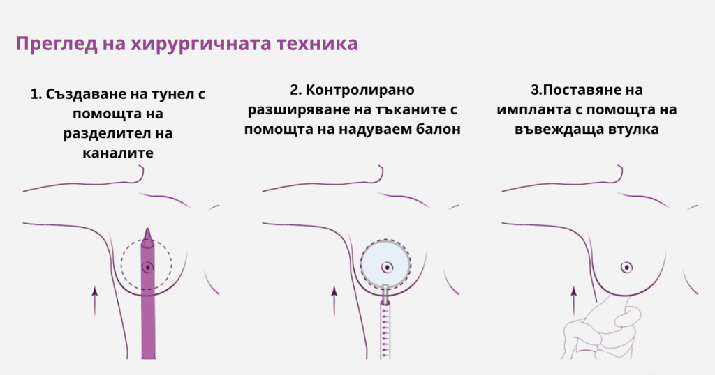Увеличаване на гърдите с Preserve 1 Увеличаване на гърдите с Preserve