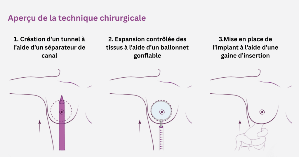 Préserver l'augmentation mammaire 1 Préserver l'augmentation mammaire