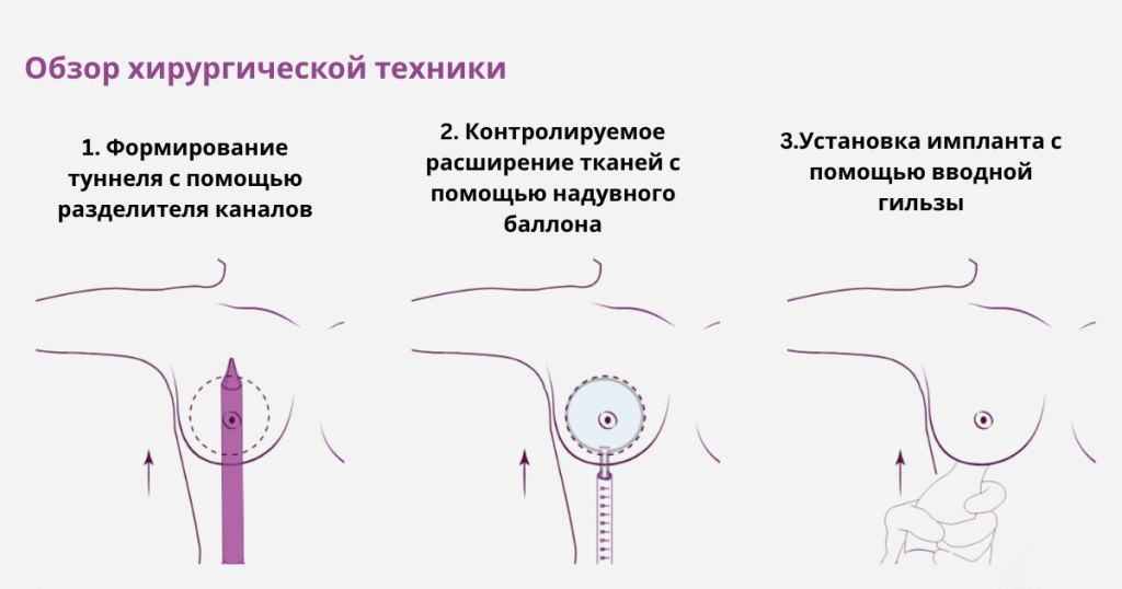 Увеличение груди с помощью Preserve 1 Увеличение груди с помощью Preserve